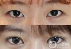 做高分子雙眼皮多少錢？高分子雙眼皮價格介紹
