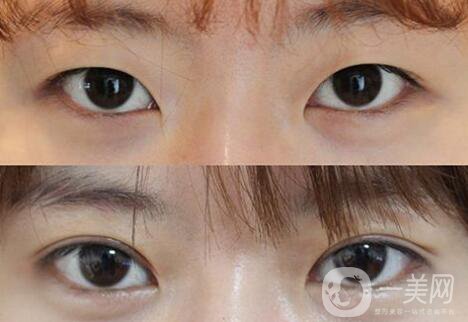 做高分子雙眼皮多少錢？高分子雙眼皮價(jià)格介紹