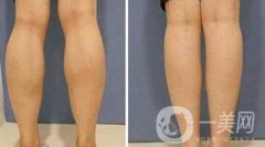 注射瘦臉要多少錢？注射注射瘦臉價格詳細介紹