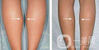 *要多少錢？注射*價格詳細介紹