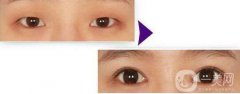 開眼角的果到底怎么樣？開眼角前后圖