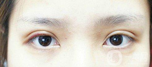 眼睛埋線幾年后的危害有些什么？