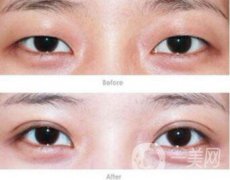 焊接雙眼皮果怎么樣？焊接雙眼皮有什么缺點(diǎn)