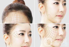 *面部提升術(shù)詳細(xì)介紹？*果怎么樣