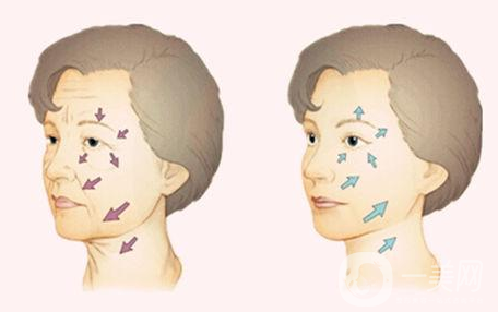 小切口拉皮除皺術(shù)*果一般能維持幾年？