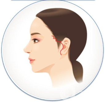 小切口拉皮除皺術(shù)*果一般能維持幾年？