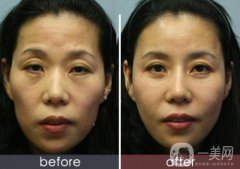 自體脂肪臉部填充果可以維持多久？