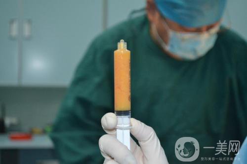 自體脂肪臉部填充*果可以維持多久？