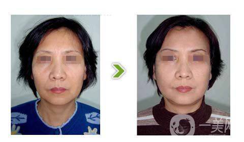 光子嫩膚的*果前后有什么變化？