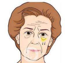 做超聲法去眼袋*果好嗎？