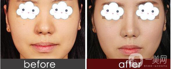 瑞蘭玻尿酸,價(jià)格