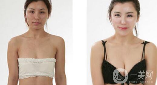 娜綺麗,假體隆胸,維持時間