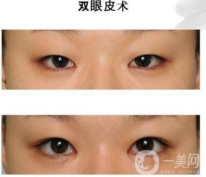 高分子雙眼皮