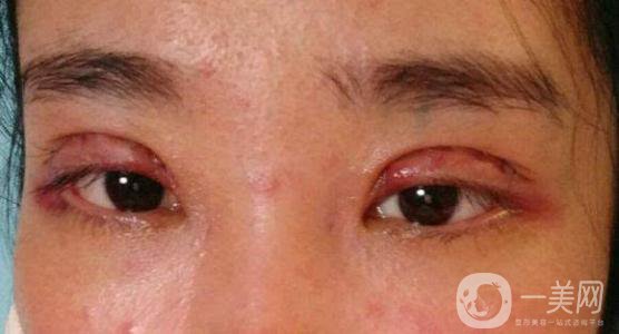 做完韓式三點雙眼皮之后眼睛會腫嗎？