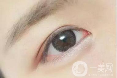 做完韓式三點雙眼皮之后眼睛會腫嗎？