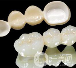 做普通烤瓷牙一般需要多少錢？