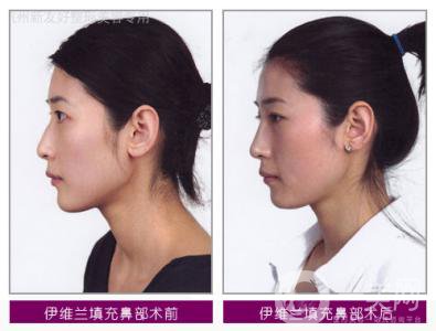 伊維蘭除皺多少錢 價(jià)格是多少？