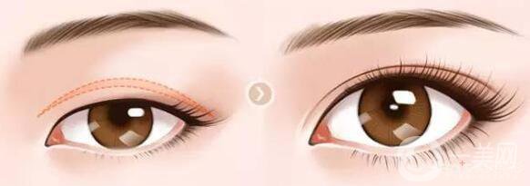 上瞼下垂矯正手術(shù)要多少錢？