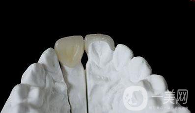 美容冠多少錢 價格詳情介紹