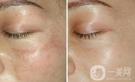 如何去蝴蝶斑、去蝴蝶斑用什么方法好？