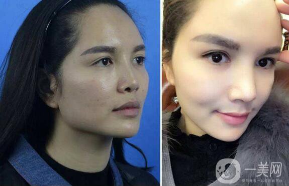 磨下頜角價(jià)格 磨下頜角費(fèi)用詳細(xì)介紹