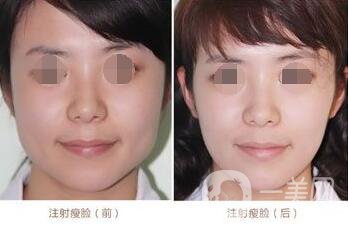 *一針要多少錢(qián) 正規(guī)醫(yī)院*價(jià)格貴嗎