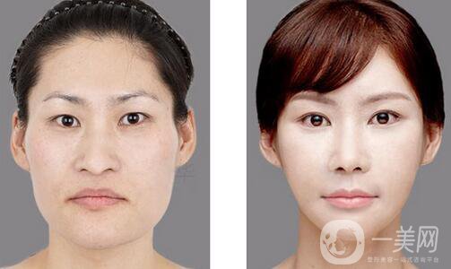 做改臉型要多少錢 做改臉型價(jià)格盤點(diǎn)
