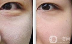 做完光子嫩膚要怎么護理 光子嫩膚后注意事項介紹