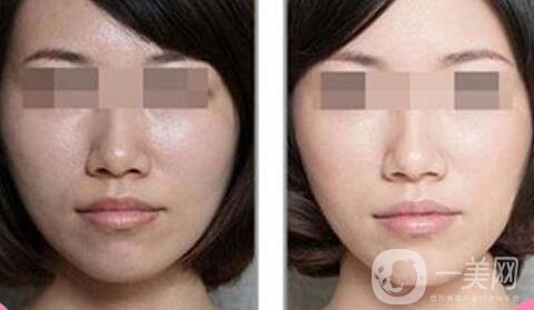 做完光子嫩膚要怎么護理 光子嫩膚后注意事項介紹