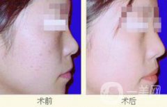 光子嫩膚價格是多少 光子嫩膚多少錢一次