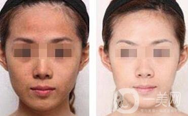 光子嫩膚價格是多少 光子嫩膚多少錢一次