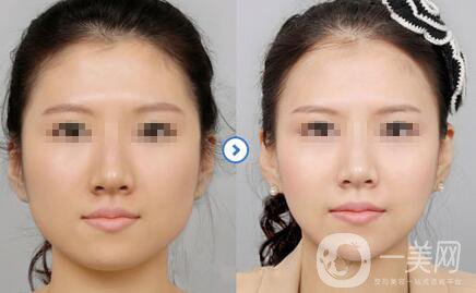 切咬肌多少錢？還會長出來嗎？