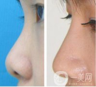 耳軟骨墊鼻尖手術(shù)做完需要多久恢復(fù)正常？