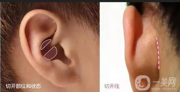 耳軟骨墊鼻尖手術(shù)做完需要多久恢復(fù)正常？