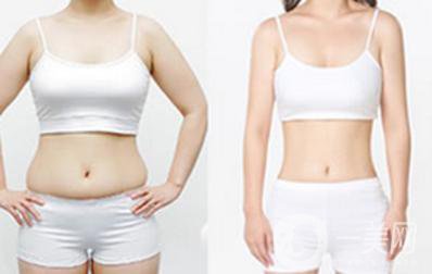 北京吸脂瘦腰減肥手術(shù)價(jià)錢(qián)是多少 價(jià)格一覽