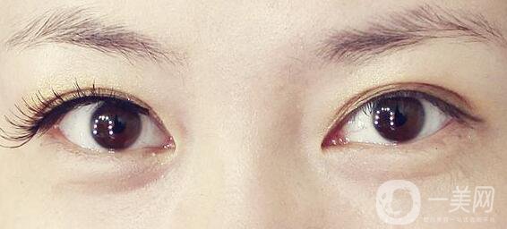 不開刀的雙眼皮是*的嗎？