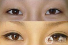 上海九院割雙眼皮多少錢 上海九院做雙眼皮價格詳解