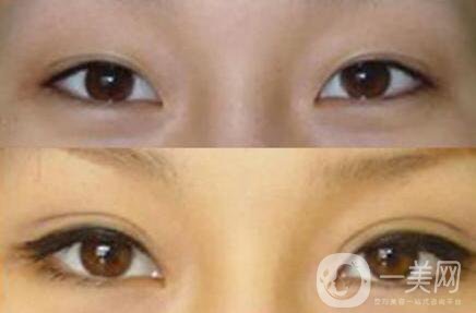 上海九院割雙眼皮多少錢 上海九院做雙眼皮價(jià)格詳解