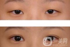 威海割雙眼皮多少錢？雙眼皮手術價格詳解