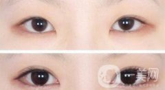韓式*開(kāi)眼角多少錢(qián)  韓式*開(kāi)眼角恢復(fù)圖