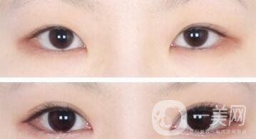 韓式*開眼角多少錢  韓式*開眼角恢復(fù)圖