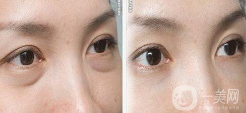 超聲法去眼袋怎么樣 超聲法祛眼袋多少錢(qián)