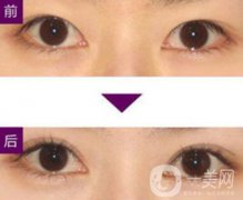 三點(diǎn)定位雙眼皮手術(shù)有副作用嗎、果怎么樣