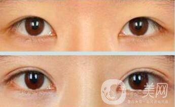 三點定位雙眼皮手術(shù)有副作用嗎、*果怎么樣