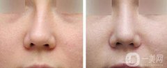 矯正鼻子大概多少錢？矯正鼻子多少費用詳情