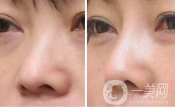 上?？s小鼻頭手術(shù)多少錢 縮小鼻頭整形價(jià)格介紹