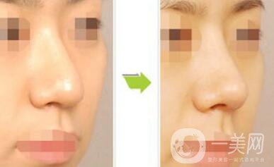 上?？s小鼻頭手術(shù)多少錢 縮小鼻頭整形價(jià)格介紹