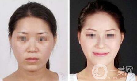 注射隆鼻一般多少錢？廣東隆鼻注射價(jià)格介紹