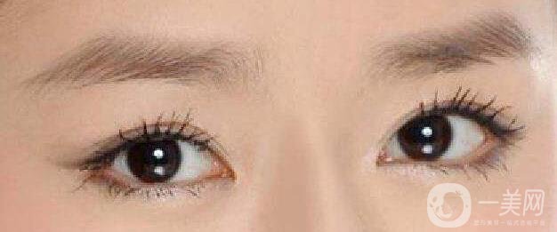 成都,割雙眼皮,多少錢(qián)