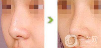 杭州駝峰鼻矯正多少錢 駝峰鼻手術(shù)價(jià)格